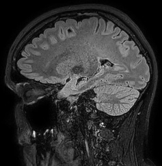 Cerebral arteriovenous malformation (Radiopaedia 74411-85654 Sagittal FLAIR 42).jpg