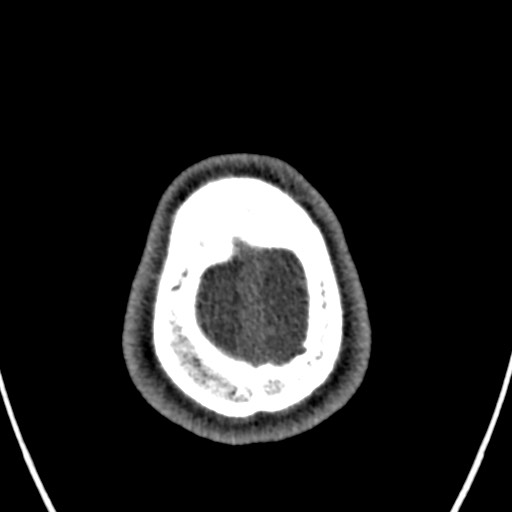 Cerebral arteriovenous malformation (Radiopaedia 78188-90746 Axial non-contrast 171).jpg