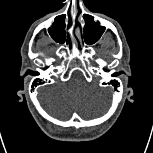 Cerebral arteriovenous malformation (Radiopaedia 78188-90746 Axial non-contrast 32).jpg