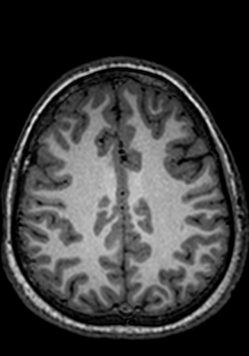 File:Cerebral arteriovenous malformation at posterior body of corpus callosum (Radiopaedia 74111-84925 Axial T1 79).jpg