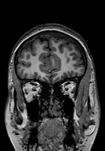 Cerebral arteriovenous malformation at posterior body of corpus callosum (Radiopaedia 74111-84925 Coronal T1 44).jpg