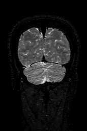 Cerebral arteriovenous malformation at posterior body of corpus callosum (Radiopaedia 74111-84925 Coronal T2 158).jpg