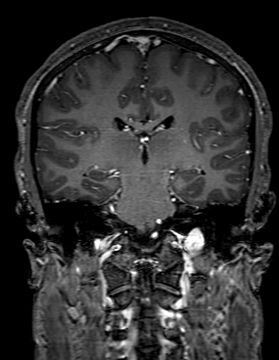 Cerebral arteriovenous malformation at posterior body of corpus callosum (Radiopaedia 74111-84925 K 210).jpg