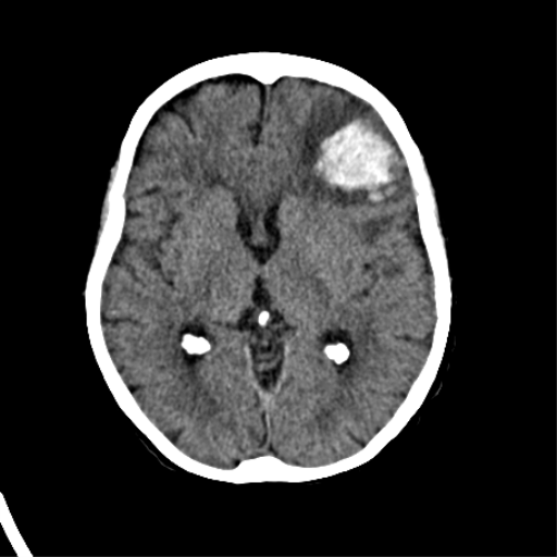 File:Cerebral arteriovenous malformation with lobar hemorrhage (Radiopaedia 44725-48510 Axial non-contrast 22).png