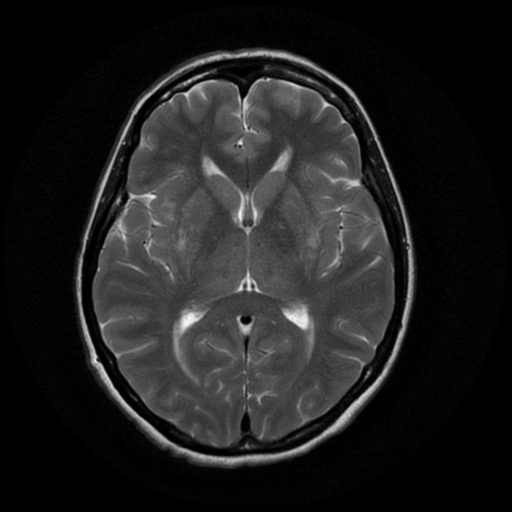 File:Cerebral autosomal dominant arteriopathy with subcortical infarcts and leukoencephalopathy (CADASIL) (Radiopaedia 41018-43763 Ax T2 PROP 11).png
