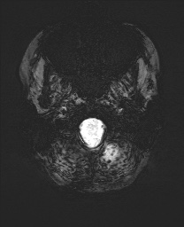 Cerebral cavernous venous malformation (Radiopaedia 70008-80021 Axial SWI 2).jpg