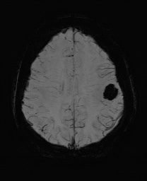 Cerebral cavernous venous malformation (Radiopaedia 70008-80021 Axial SWI 50).jpg