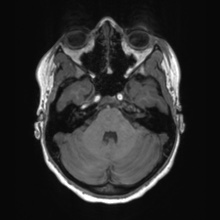 File:Cerebral cavernous venous malformation (Radiopaedia 70008-80021 Axial T1 17).jpg