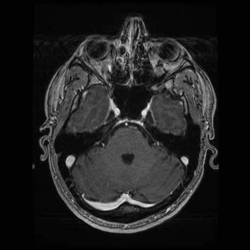 Cerebral cavernous venous malformation (Zabramski type II) (Radiopaedia 85511-101198 Axial T1 C+ fat sat 61).jpg