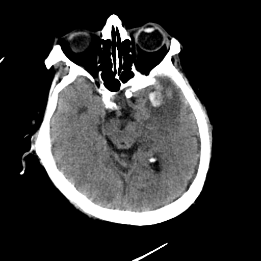 File:Cerebral contusions, subarachnoid hemorrhage and subdural hygromas (Radiopaedia 55399-61830 Axial non-contrast 13).png