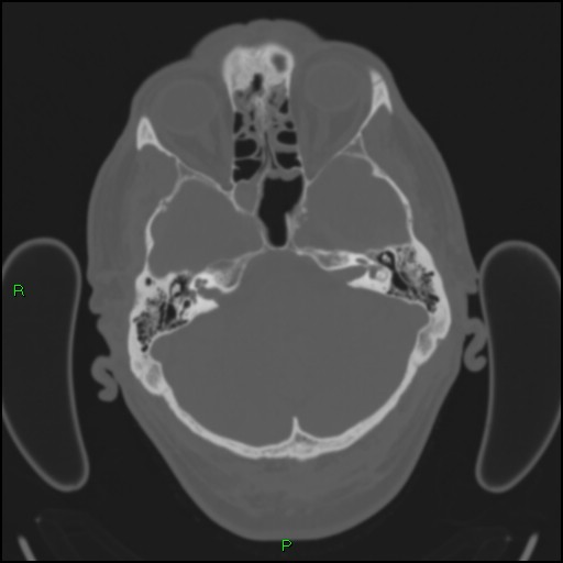 Cerebral contusions (Radiopaedia 33868-35039 Axial bone window 46).jpg