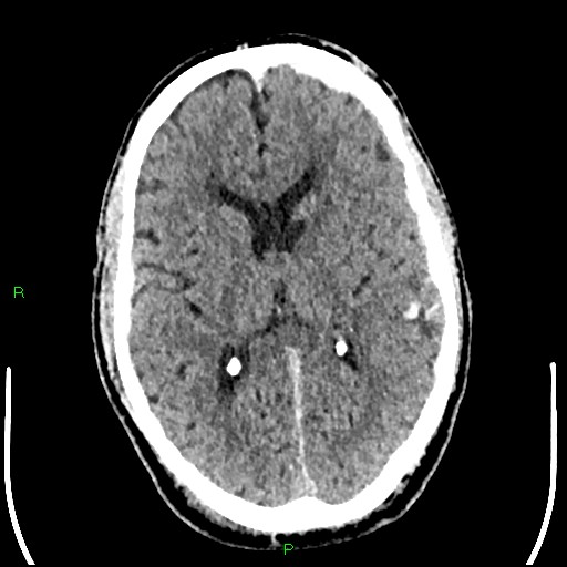Cerebral contusions (Radiopaedia 33868-35039 Axial non-contrast 114).jpg