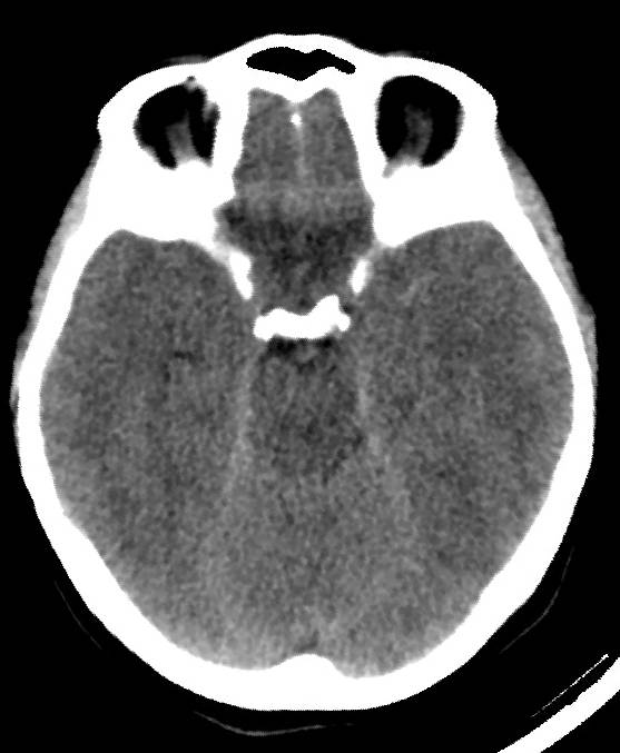 Cerebral edema due to severe hyponatremia (Radiopaedia 89826-106937 Axial non-contrast 33).jpg