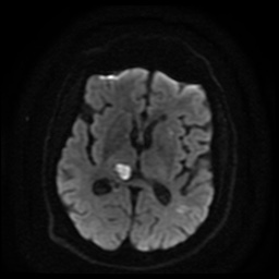 Cerebral embolic infarcts (embolic shower) (Radiopaedia 49837-55108 Axial DWI 71).jpg