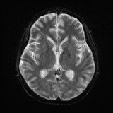 Cerebral embolic infarcts (embolic shower) (Radiopaedia 72391-82921 Axial DWI 15).jpg