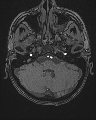 Cerebral embolic infarcts (embolic shower) (Radiopaedia 72391-82921 Axial MRA 16).jpg