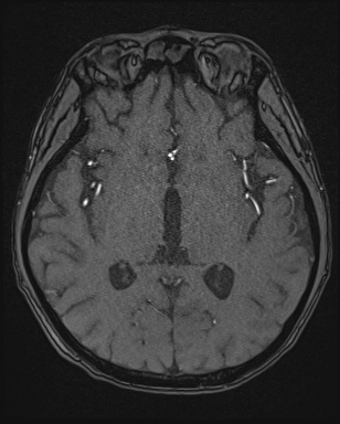File:Cerebral embolic infarcts (embolic shower) (Radiopaedia 72391-82921 Axial MRA 87).jpg