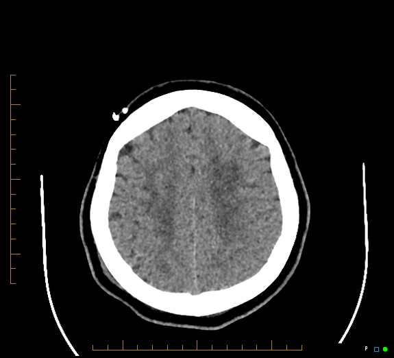 File:Cerebral fat embolism (Radiopaedia 85521-101220 Axial non-contrast 47).jpg