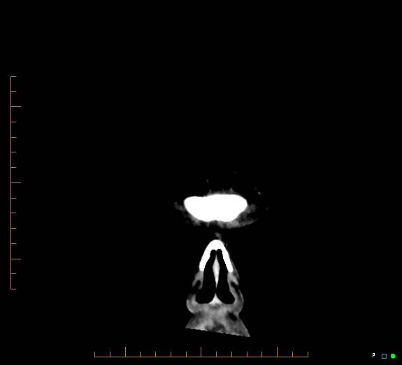 Cerebral fat embolism (Radiopaedia 85521-101220 Coronal non-contrast 3).jpg