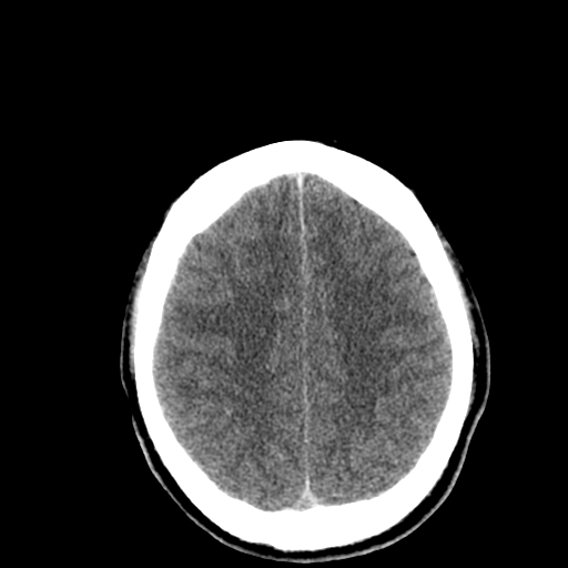 File:Cerebral hemorrhagic contusions- temporal evolution (Radiopaedia 40224-42753 Axial non-contrast 25).png