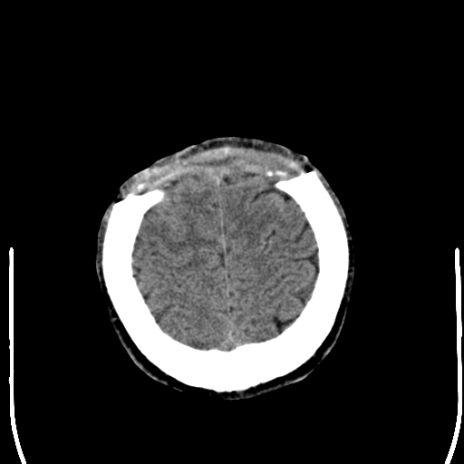 File:Cerebral hemorrhagic contusions- temporal evolution (Radiopaedia 40224-42756 Axial non-contrast 24).png