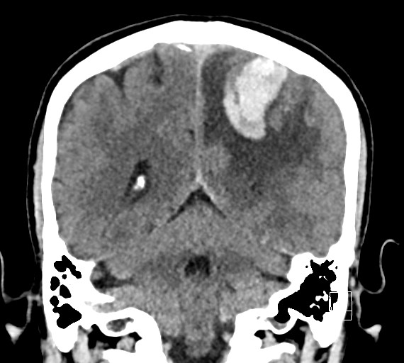 Cerebral metastases - testicular choriocarcinoma (Radiopaedia 84486-99855 Coronal C+ delayed 43).jpg