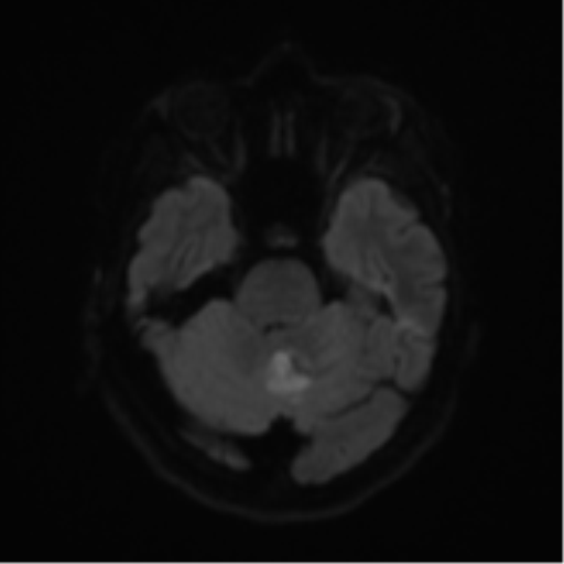 Cerebral metastases mimicking abscesses (Radiopaedia 45841-50131 Axial DWI 38).png