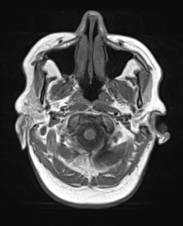 File:Cerebral metastases mimicking abscesses (Radiopaedia 45841-50131 Axial T1 3).png