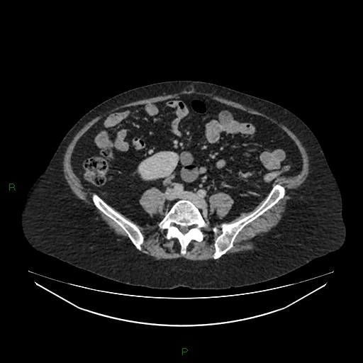 Cerebral metastasis from renal cell carcinoma (Radiopaedia 82306-96378 A 120).jpg