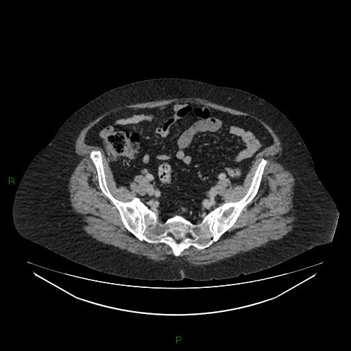 Cerebral metastasis from renal cell carcinoma (Radiopaedia 82306-96378 A 146).jpg