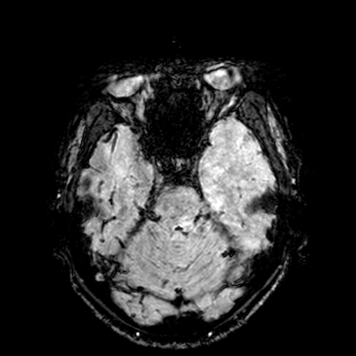 Cerebral parenchymal arteriovenous malformation (Radiopaedia 27280-27456 Axial SWI 30).jpg