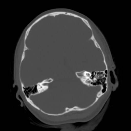 Cerebral tuberculosis with dural sinus invasion (Radiopaedia 60353-68018 Axial bone window 15).jpg