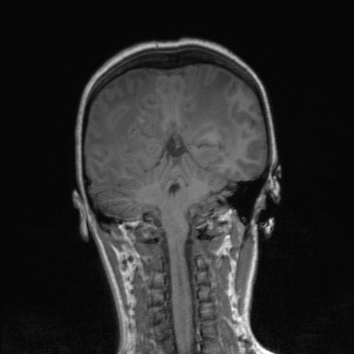 File:Cerebral tuberculosis with dural sinus invasion (Radiopaedia 60353-68090 Coronal T1 128).jpg