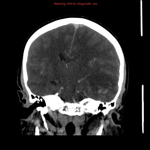 Cerebral venous infarction (Radiopaedia 12404-20735 B 43).jpg