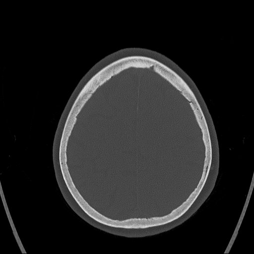 Cerebral venous infarction with hemorrhage (Radiopaedia 65343-74381 Axial bone window 151).jpg