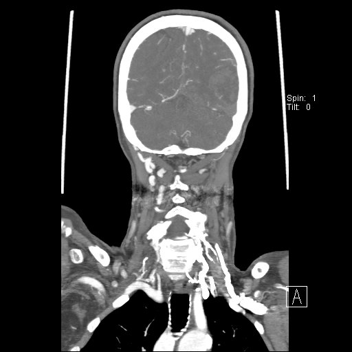 Cerebral venous infarction with hemorrhage (Radiopaedia 65343-74396 B 216).jpg