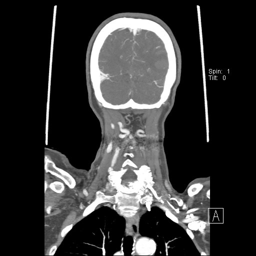 Cerebral venous infarction with hemorrhage (Radiopaedia 65343-74396 B 229).jpg
