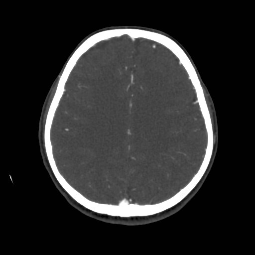 Cerebral venous sinus thrombosis (Radiopaedia 40619-43227 A 156).jpg