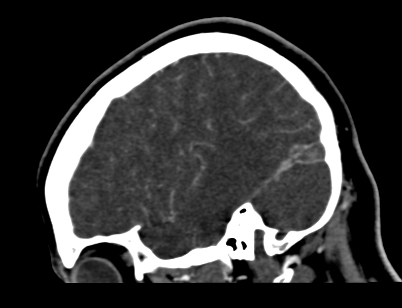 Cerebral venous sinus thrombosis (Radiopaedia 59224-66646 Sagittal C+ delayed 51).jpg