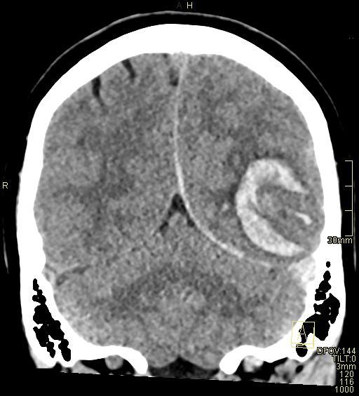 Cerebral venous sinus thrombosis (Radiopaedia 91329-108965 Coronal non-contrast 42).jpg