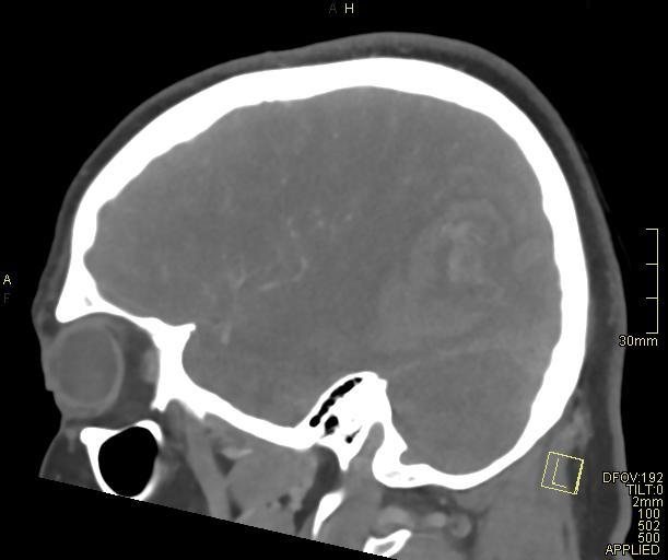 Cerebral venous sinus thrombosis (Radiopaedia 91329-108965 Sagittal venogram 57).jpg