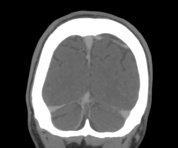 Cerebral venous thrombosis (Radiopaedia 38392-40467 Coronal CTA-Venogram 54).png