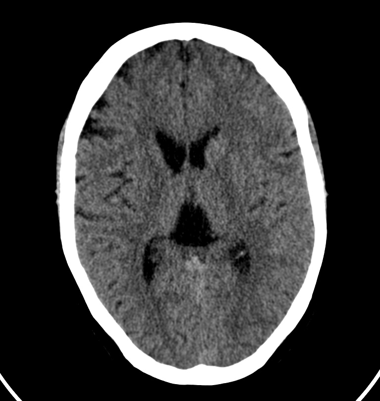 Cerebral venous thrombosis - CT only (Radiopaedia 41031-43778 Axial non-contrast 39).jpg