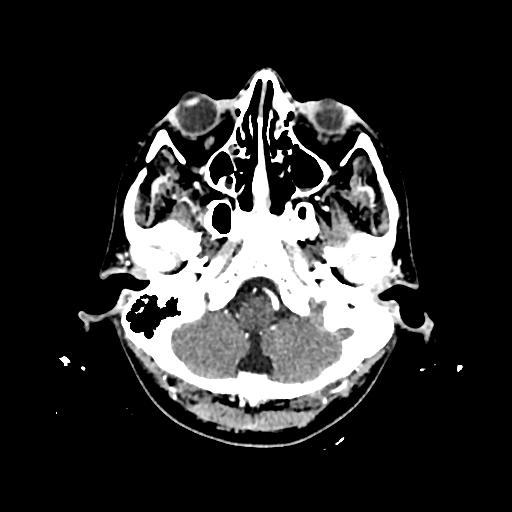 Cerebral venous thrombosis with venous hemorrhagic infarct (Radiopaedia 90354-107660 Axial with contrast 27).jpg