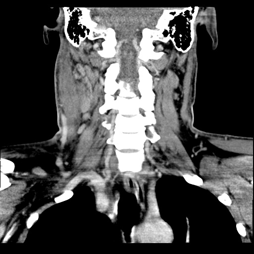 Cervical abscess (Radiopaedia 43725-47184 A 1).png