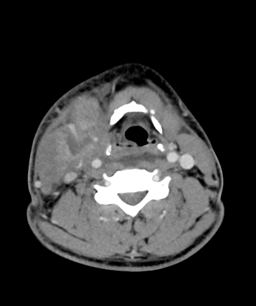 Cervical abscess (Radiopaedia 43725-47184 A 39).png