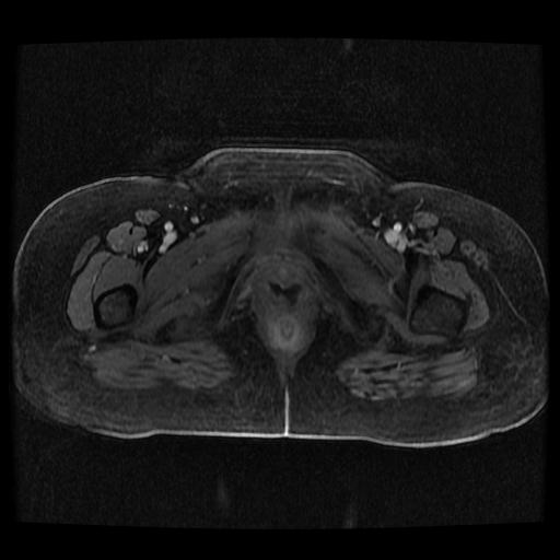 Cervical carcinoma (Radiopaedia 70924-81132 Axial T1 C+ fat sat 110).jpg