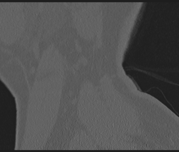 Cervical disc replacement (Radiopaedia 44025-47541 Sagittal bone window 5).png