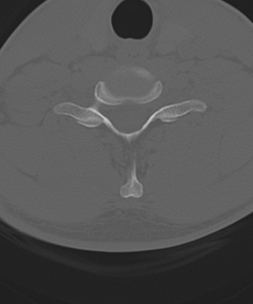 Cervical intercalary bone (Radiopaedia 35211-36748 Axial bone window 48).png