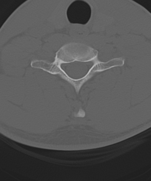 Cervical intercalary bone (Radiopaedia 35211-36748 Axial bone window 49).png